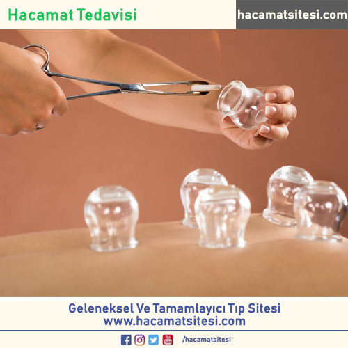 Hacamat Tedavisi