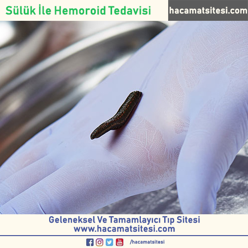 Sülük İle Hemoroid Tedavisi