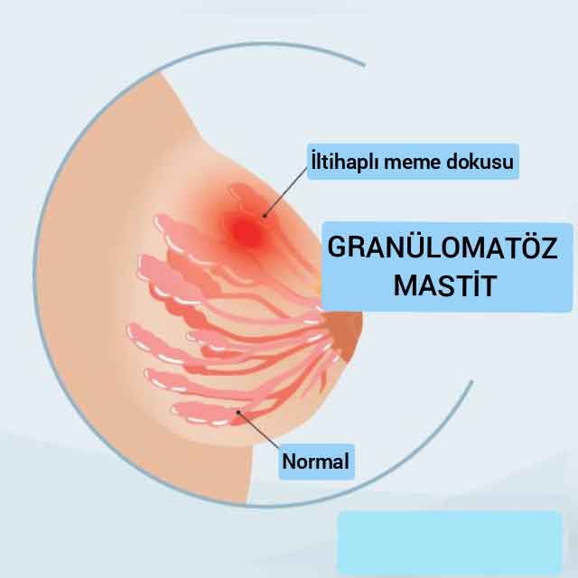 Dr Ayşegül Aytekin Granülomatöz Mastit (GM) Tedavisi